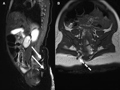 Case Report: Two cases of multiples and atypical dermal sinus tracts